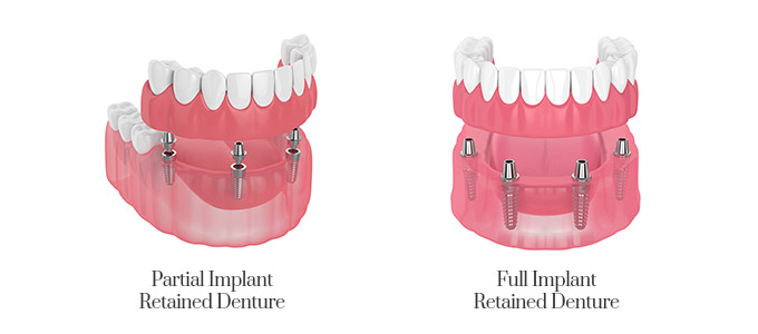ackley-implant-dentures-1