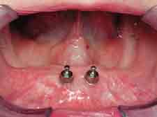 ackley-implant-dentures-procedure-1