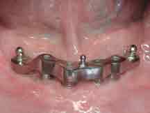 ackley-implant-dentures-procedure-4