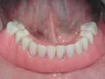 ackley-implant-dentures-procedure-7